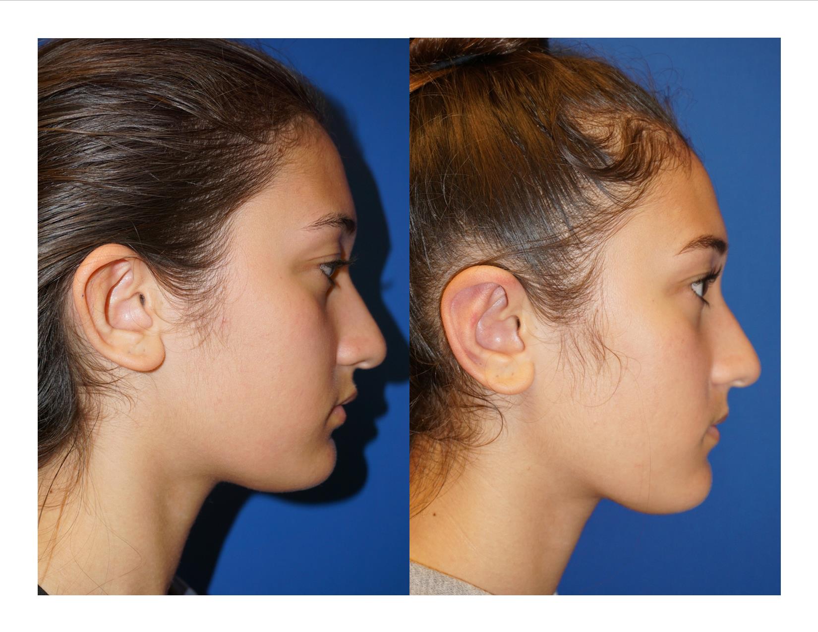 Otoplasty 2 Image 5
