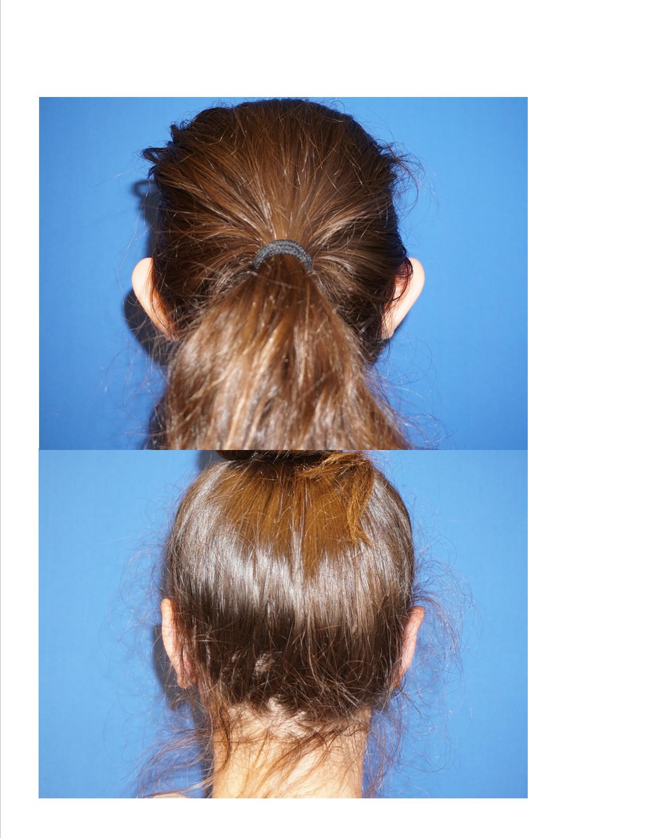 Otoplasty 2 Image 6