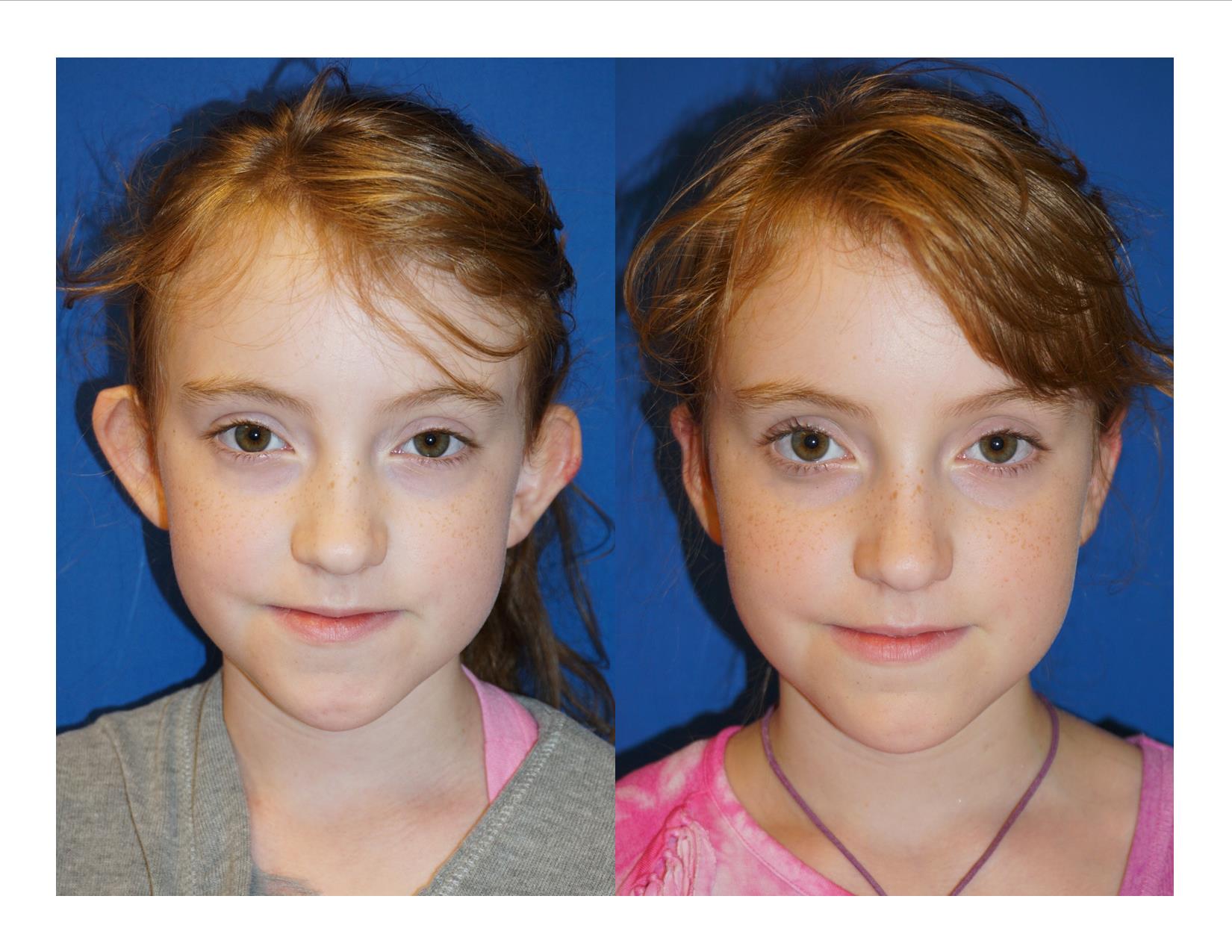 Image 1 Otoplasty 1