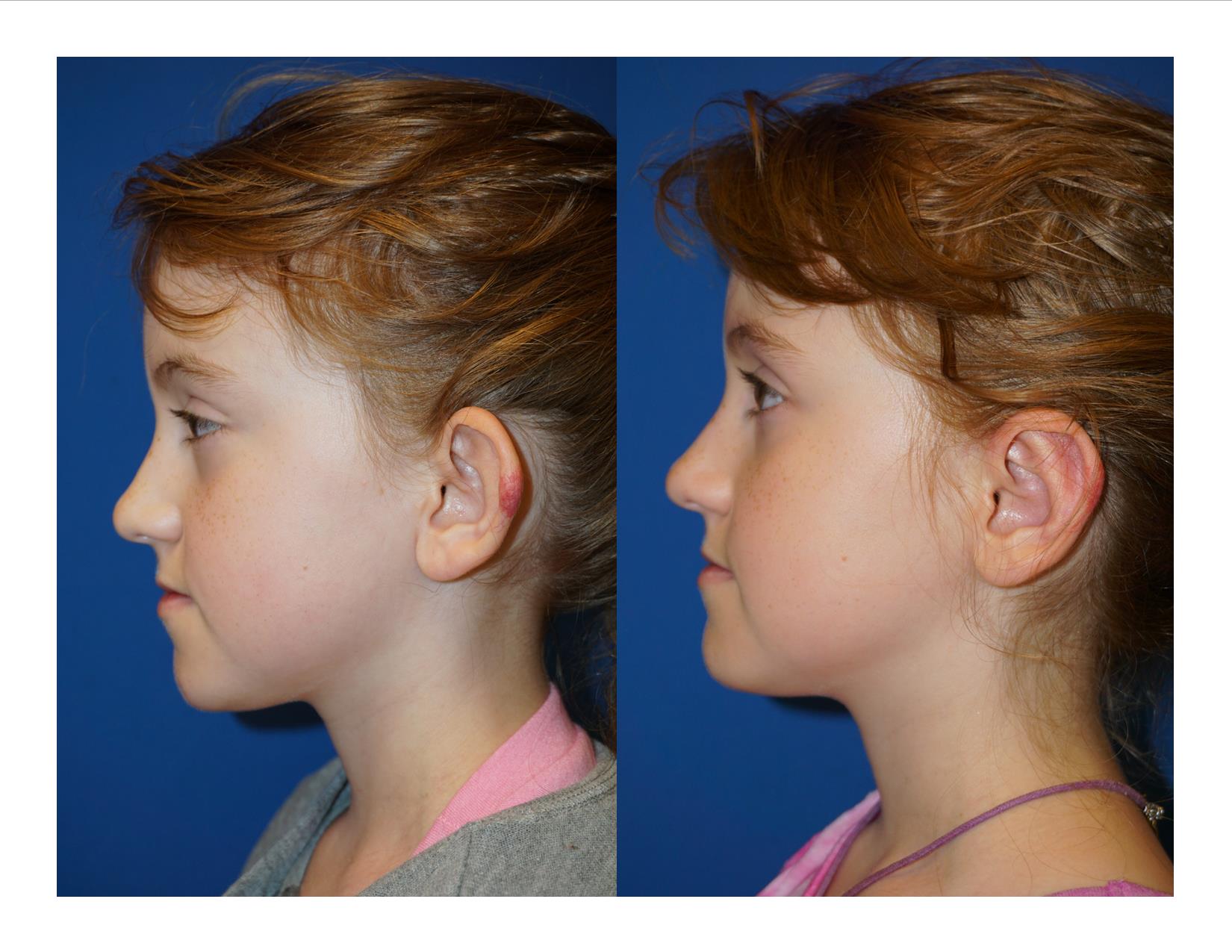 Image 3 Otoplasty 1