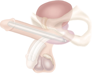 Semi-rigid penile implant
