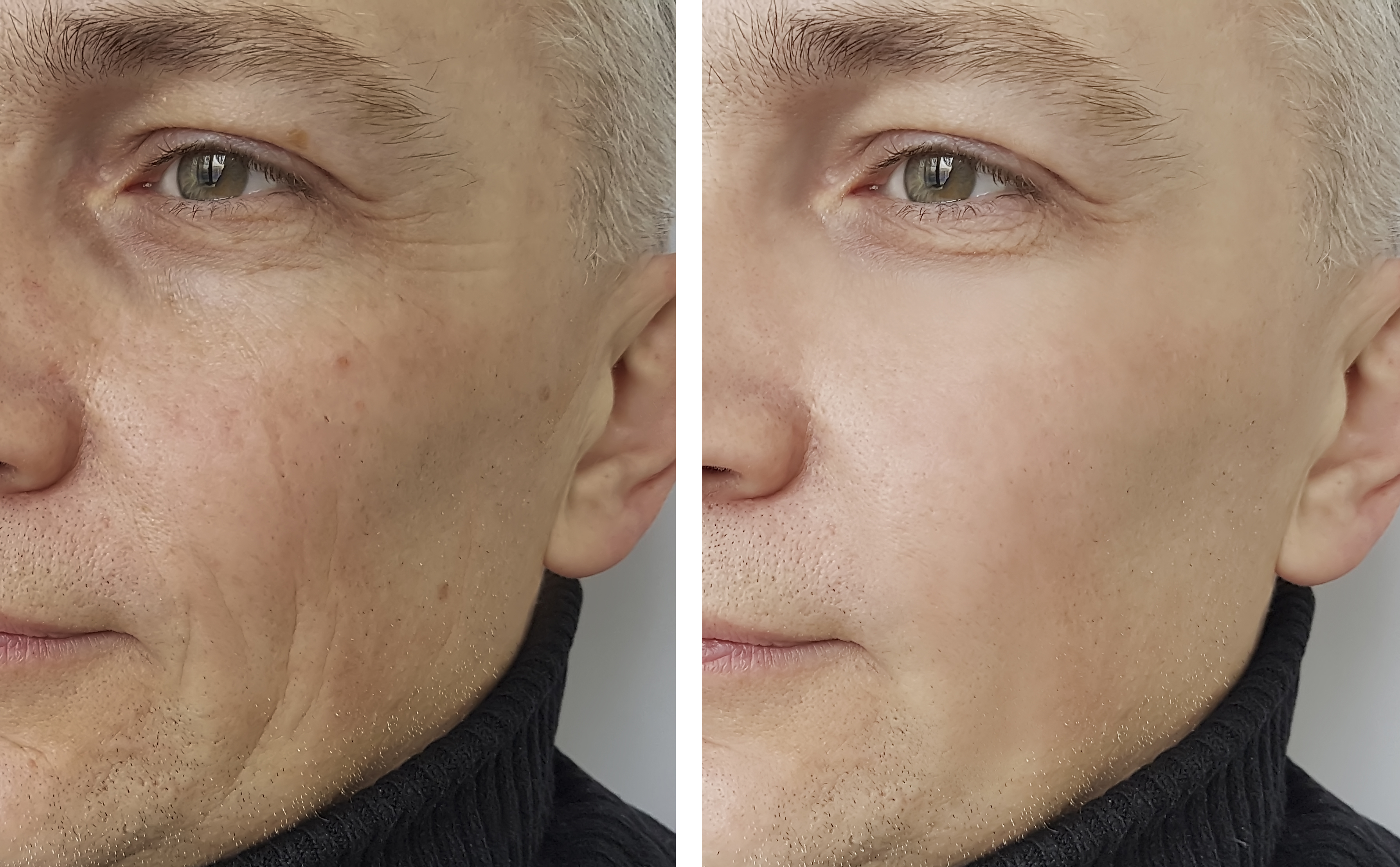 man wrinkles before and after