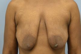 Breast Lift