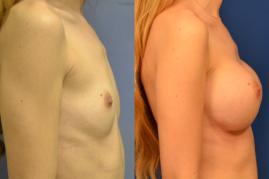 Breast_Aug_2.jpg