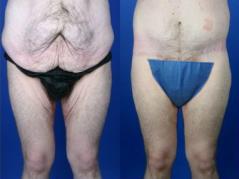 Pyo_Body_Contouring_After_Massive_Weight_Loss25919-82353FINAL.jpg