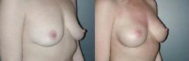 Pyo_Breast_Aug5773-66180FINAL.jpg