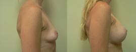 Pyo_Tummy_Tuck25933-82379FINAL.jpg