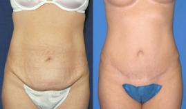 Pyo_Tummy_Tuck4515-61984FINAL.jpg