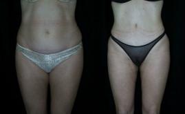 Pyo_Tummy_Tuck7088-62860FINAL.jpg