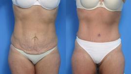 Pyo_Tummy_Tuck7375-63091FINAL.jpg