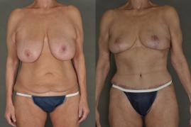mommy-makeover-p11.jpg