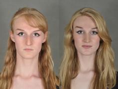 nose-rhinoplasty-p5.jpg