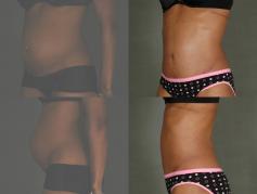 tummy-tuck-p6.jpg