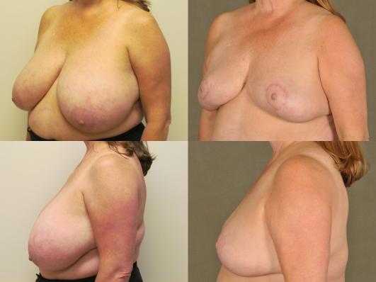 patient in her 40s with large breasts who underwent bilateral breast reduction