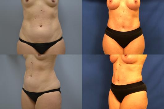 Front & Oblique view