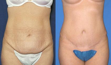 Pyo_Tummy_Tuck4515-61984FINAL.jpg