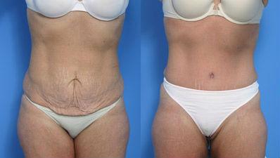 Pyo_Tummy_Tuck7375-63091FINAL.jpg
