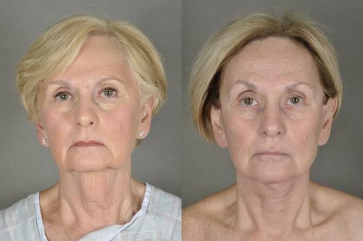 face-and-neck-lift-eyelid-surgery-p12_o9fJ78v.jpg